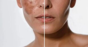 Manchas na pele? Creme coreano de vitamina C ajuda a suavizar marcas